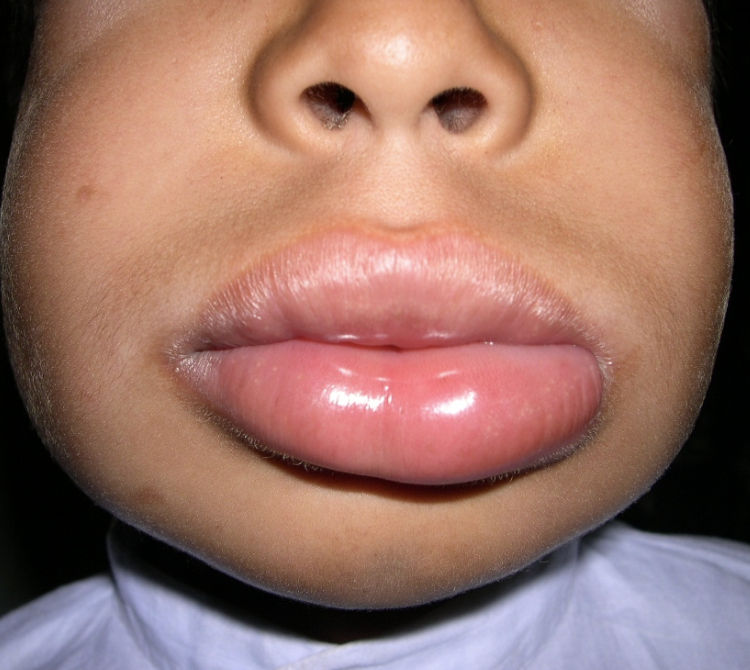 Angioedema