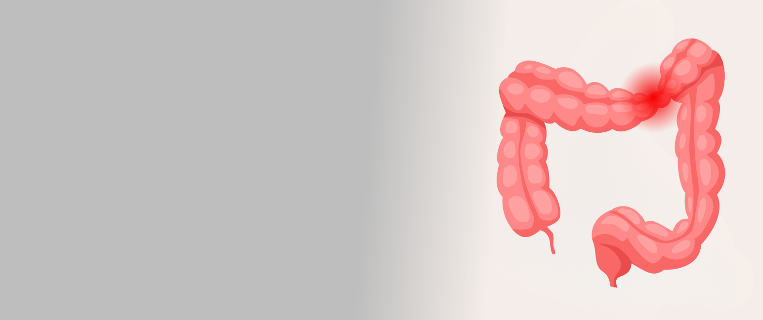 Understanding Irritable Bowel Syndrome