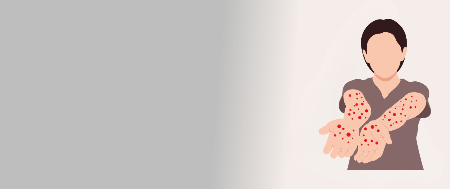 Understanding Psoriasis