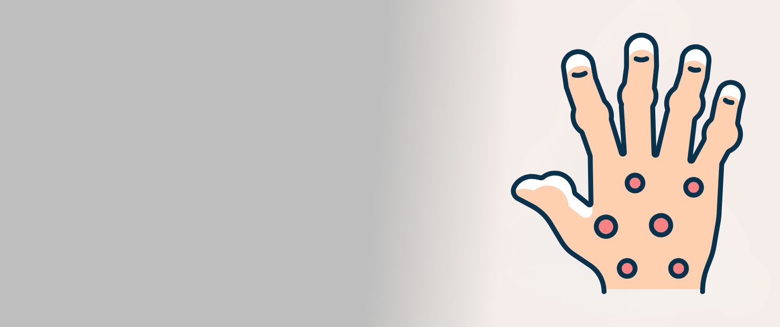 Understanding Psoriatic Arthritis