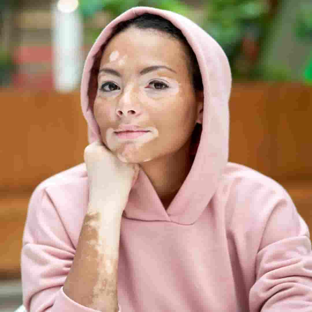 Vitiligo