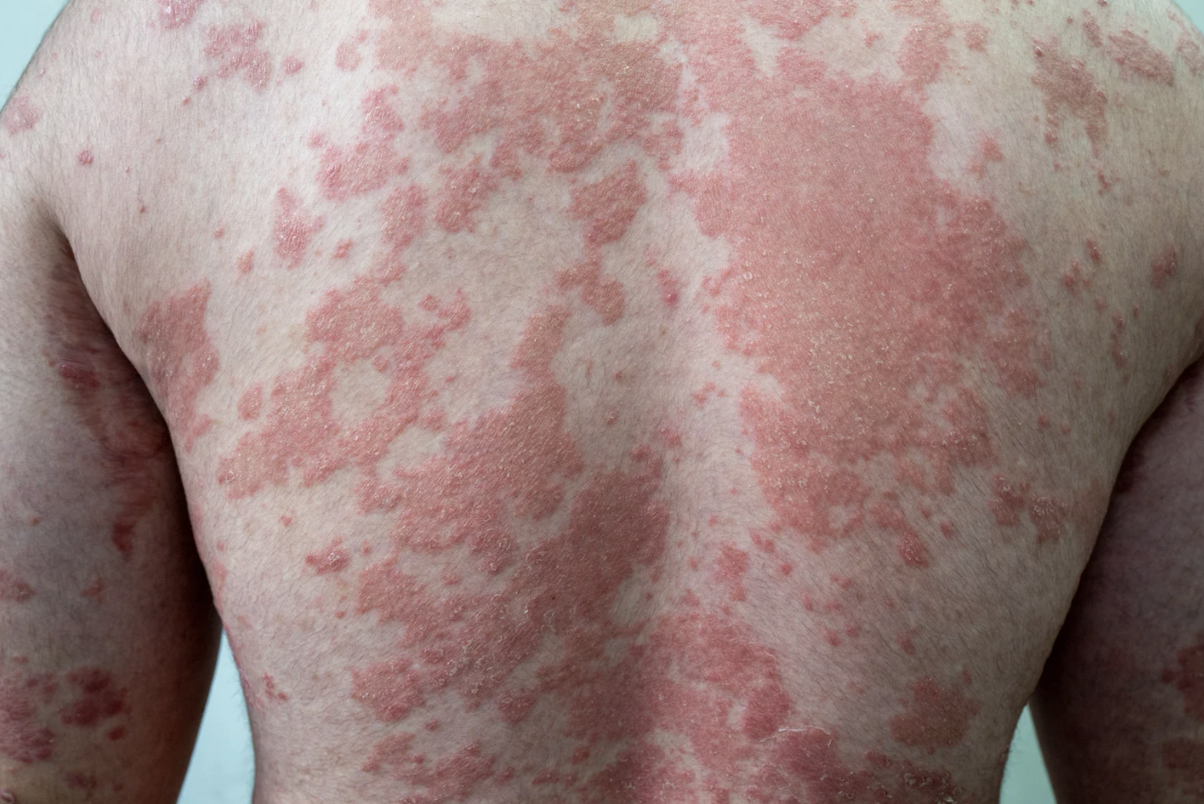 Psoriasis vulgaris