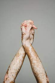 vitiligo