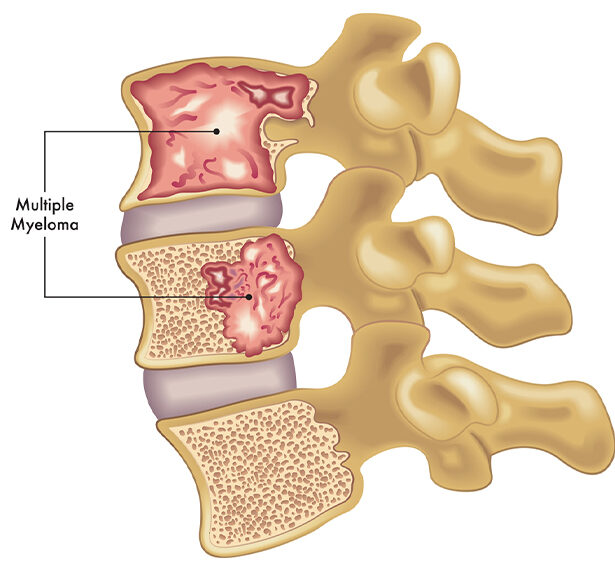 67b852d386d811264 x 571_What Is Multiple Myeloma-Understanding Symptoms And Treatment Options