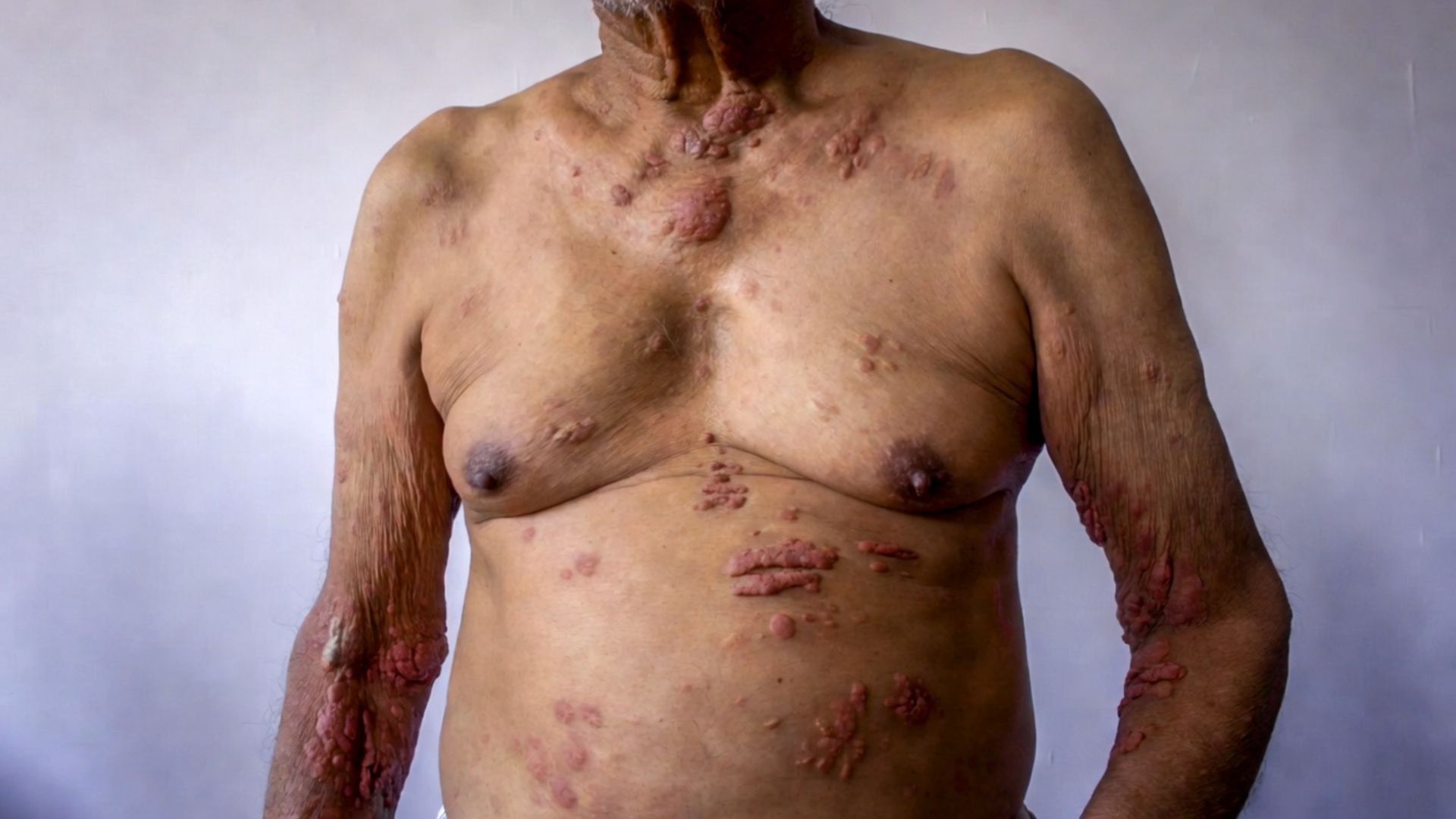 A 74-year-old male patient chronic urticaria