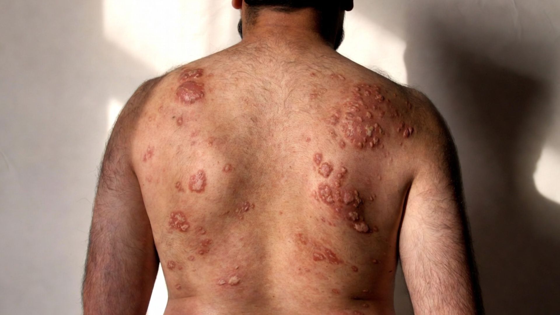 Urticaria Patient by Eliminating His Dependency on Antihistamines A 32-year-old male patient