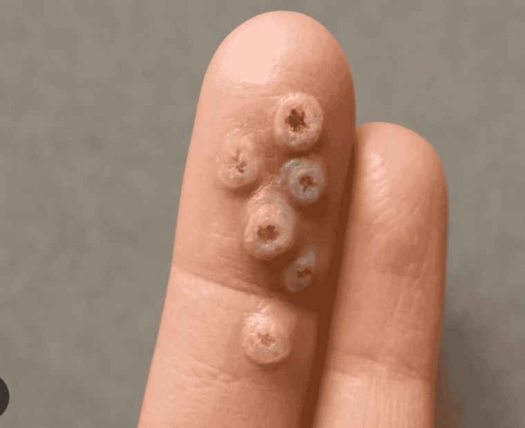 Viral warts